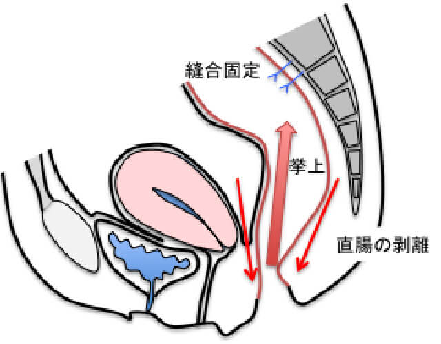 経腹的手術：直腸つり上げ固定術 開腹術